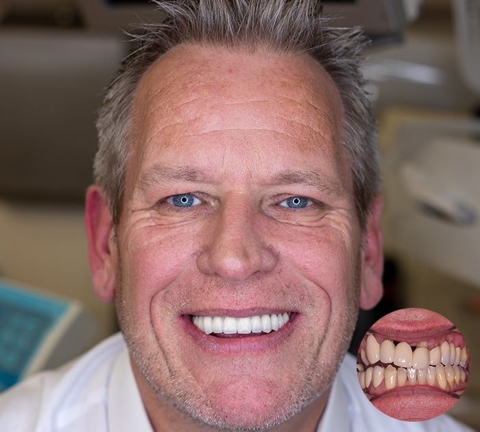 Loose Denture solutions After having Loose Denture solutions treatment